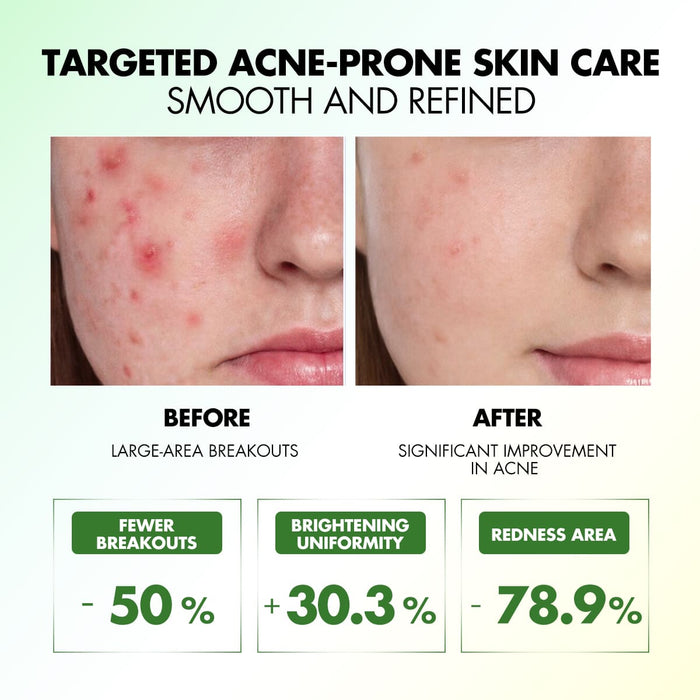 SPOTLESS ACNE CARE SERUM